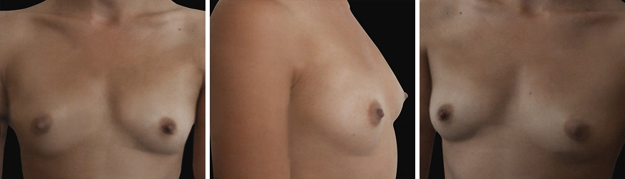 Breast Augmentation