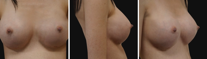 Breast Augmentation