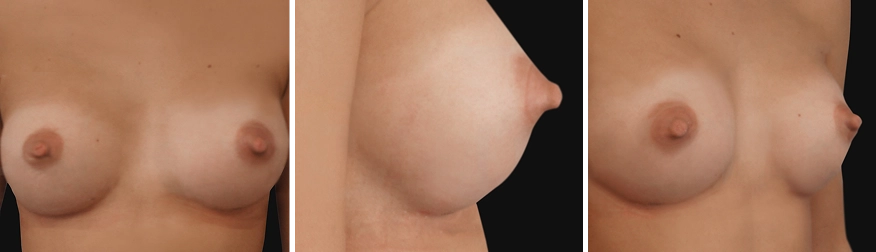 Breast Augmentation