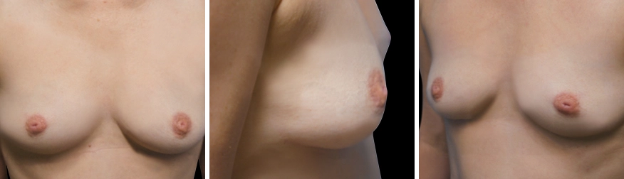 Breast Augmentation