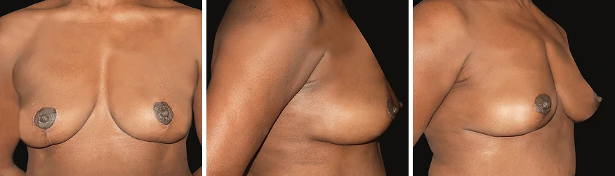 Implant Removal