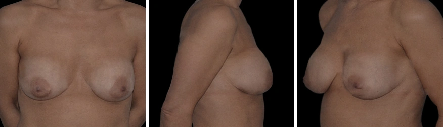 Implant Removal