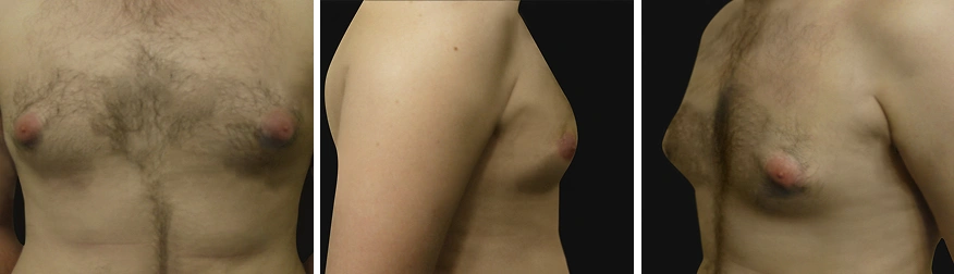Gynecomastia