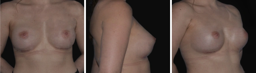 Tuberous Breast Correction