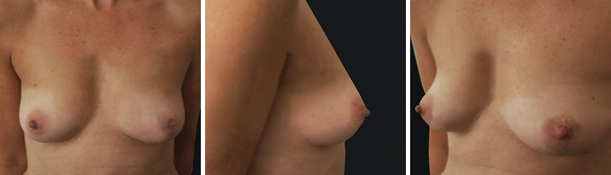 Breast Asymmetry