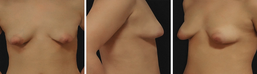 Ocean Breast Augmentation