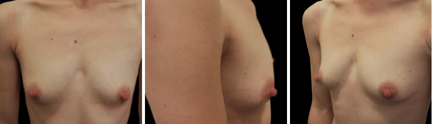 Tuberous Breast Correction