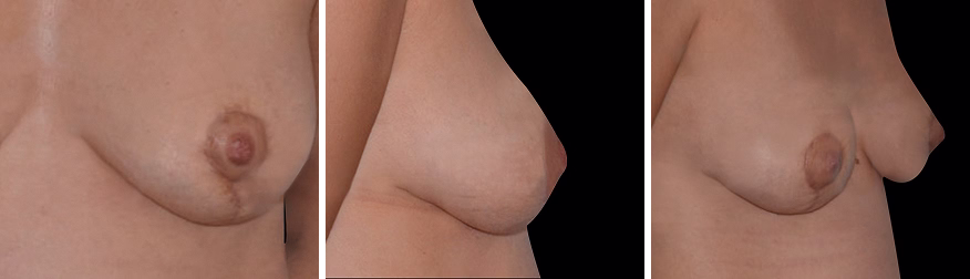 Areola Reduction