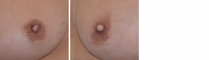 Inverted Nipple Correction