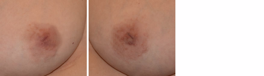 Inverted Nipple Correction