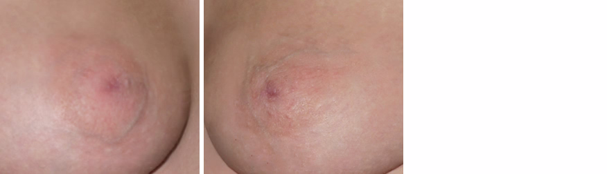 Inverted Nipple Correction