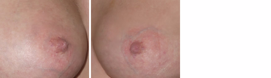 Inverted Nipple Correction