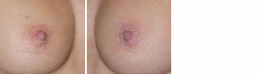 Inverted Nipple Correction