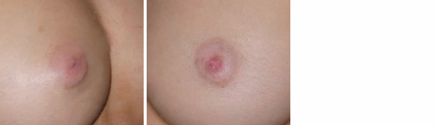 Inverted Nipple Correction