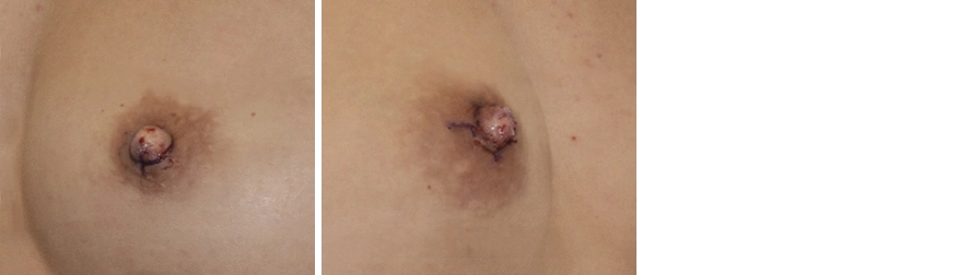 Inverted Nipple Correction