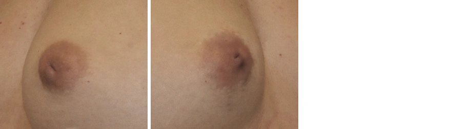 Inverted Nipple Correction