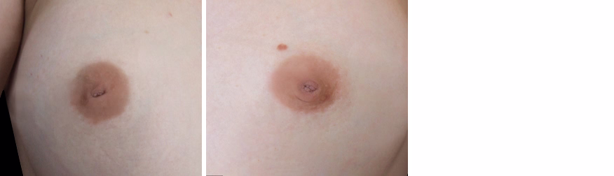 Inverted Nipple Correction