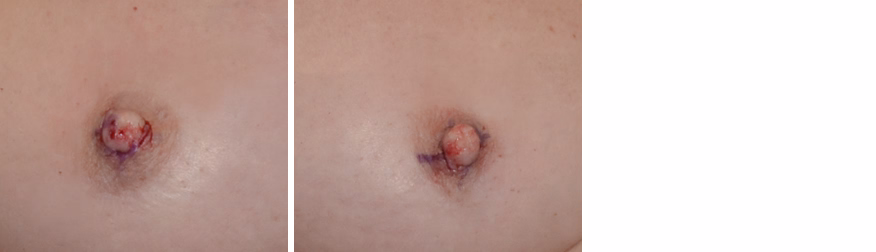 Inverted Nipple Correction