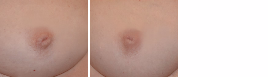 Inverted Nipple Correction