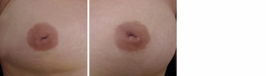 Inverted Nipple Correction