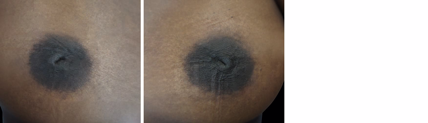 Inverted Nipple Correction