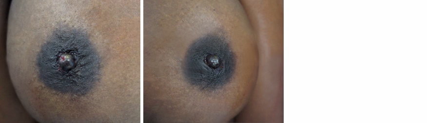 Inverted Nipple Correction