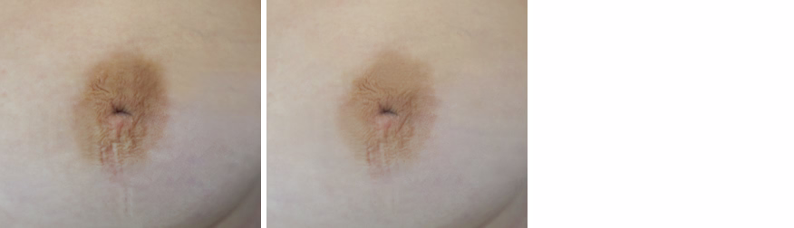 Inverted Nipple Correction
