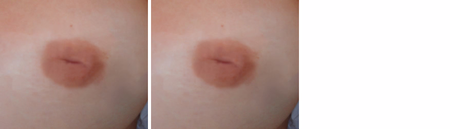 Inverted Nipple Correction