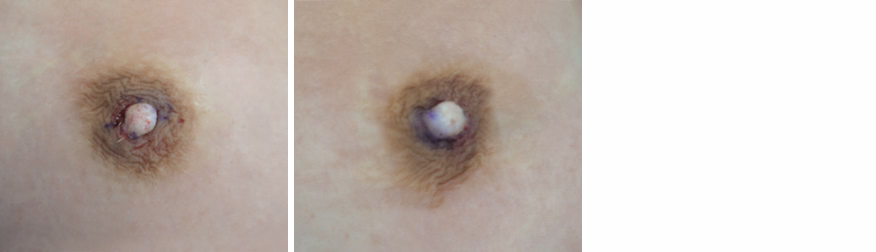 Inverted Nipple Correction