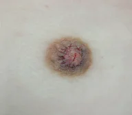 Nipple Reduction