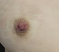 Nipple Reduction