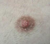 Nipple Reduction