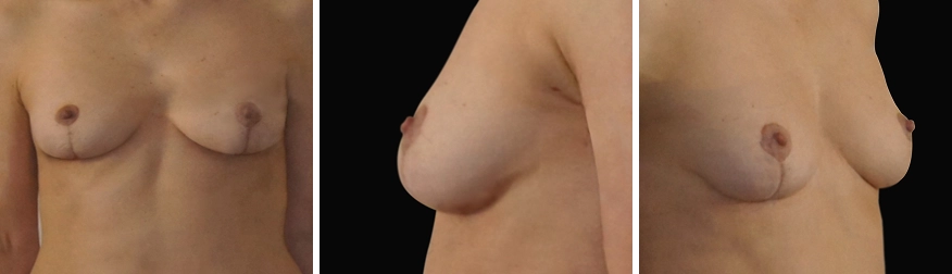 Breast Uplift