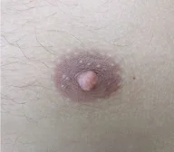 Nipple Reduction