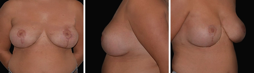 Breast Uplift