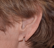 Earlobe Repair