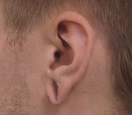 Earlobe Repair