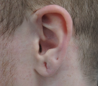 Earlobe Repair
