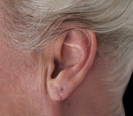 Earlobe Repair