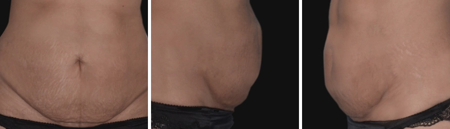 Tummy Tuck