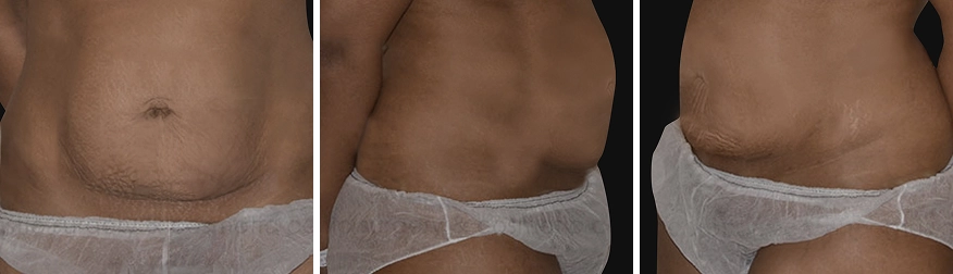 Tummy Tuck