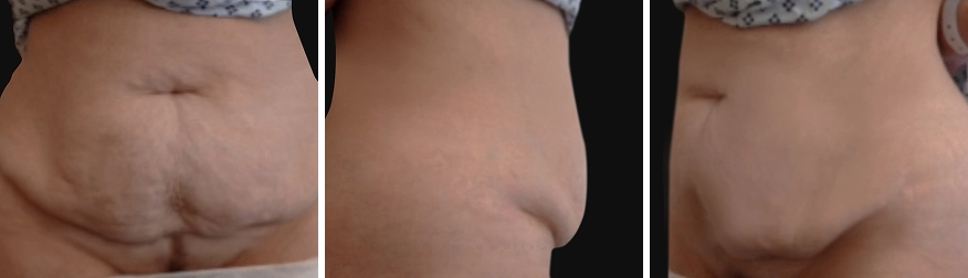 Liposuction