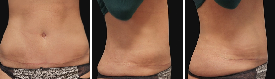Tummy Tuck
