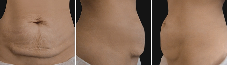 Tummy Tuck
