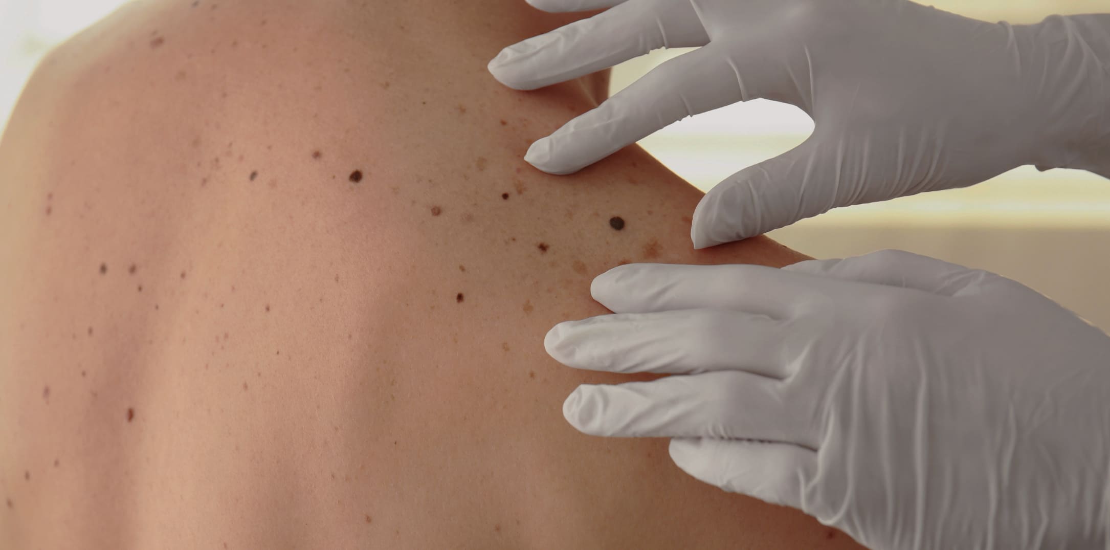 Why Regular Skin Checks Are Crucial for Early Detection