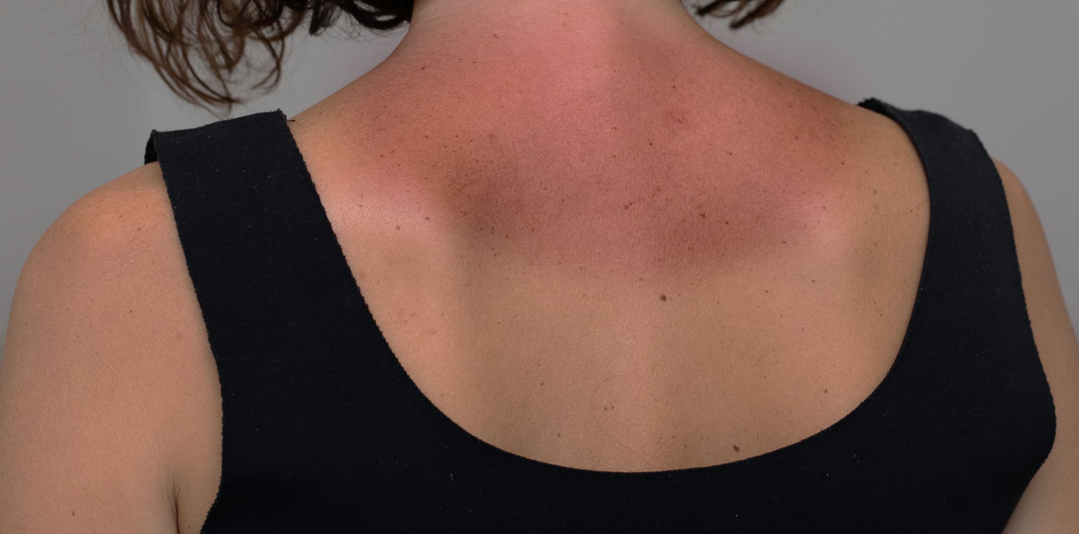 Understanding Skin Cancer Risk Factors and Prevention