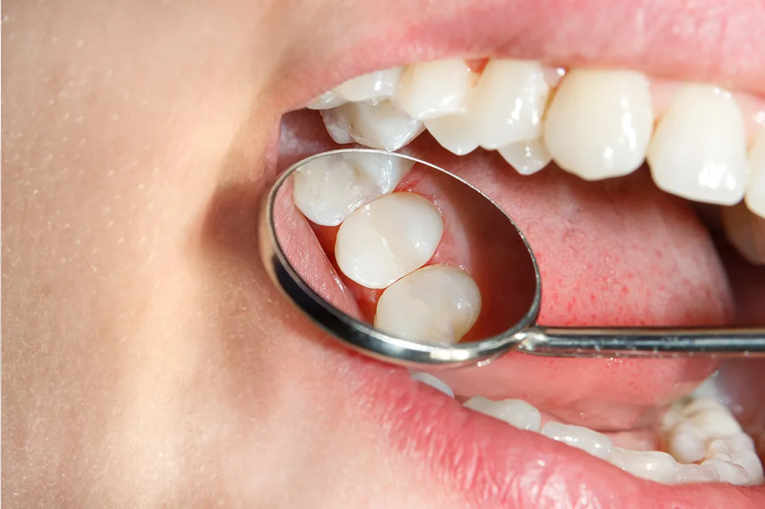 Dental Fillings