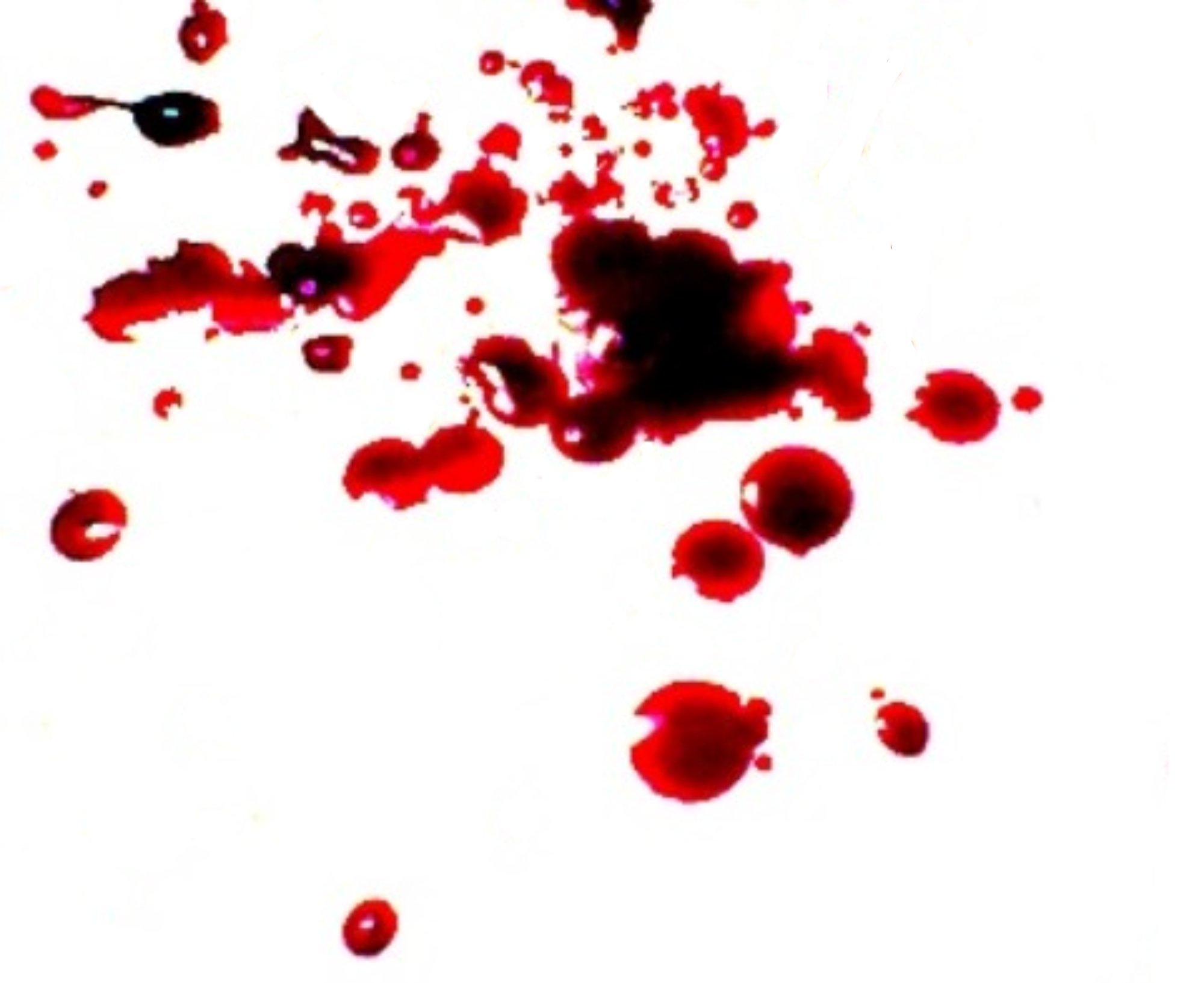 Risks of Bloodborne Pathogens & Diseases