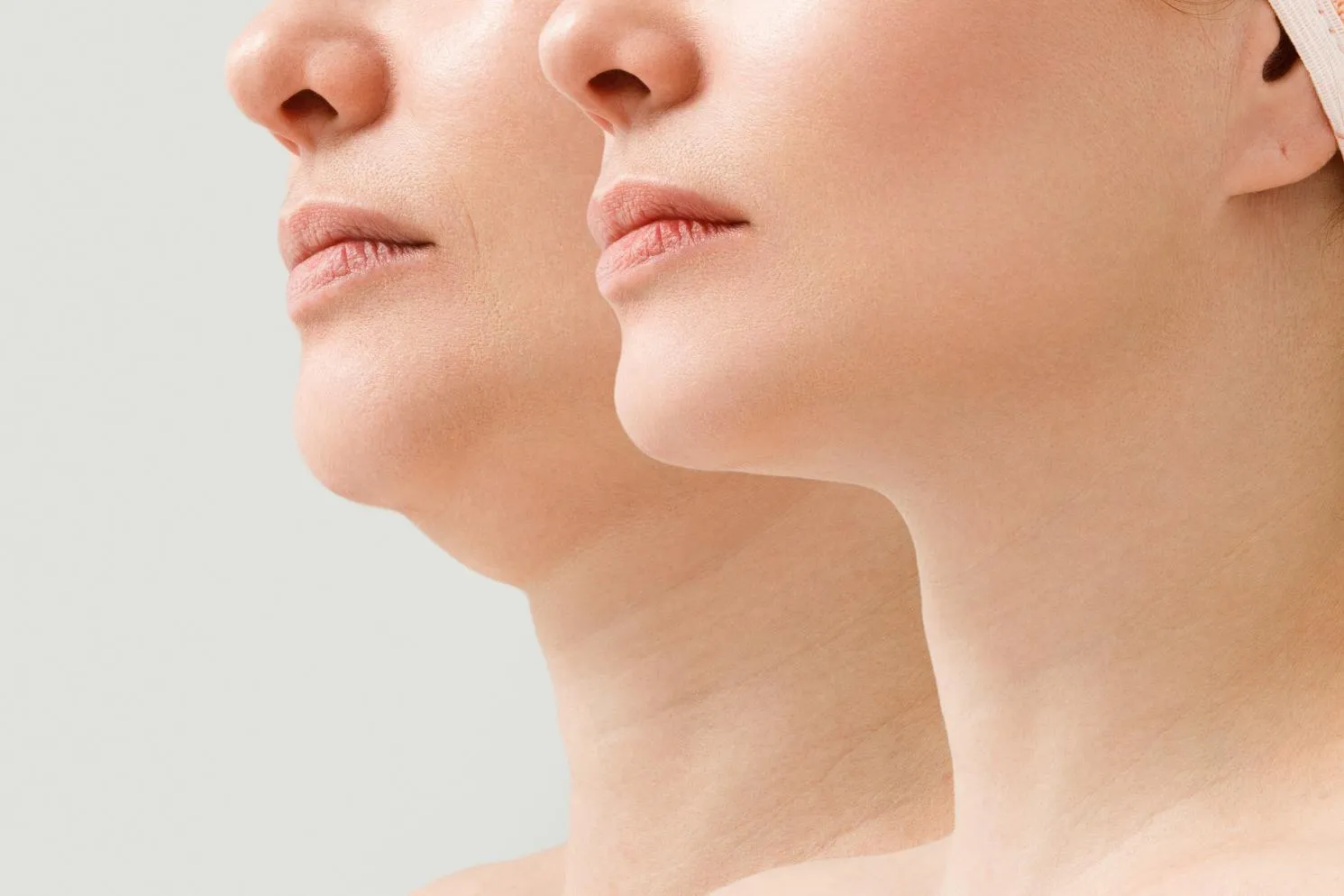 Side-by-side close-up of two female chins, one with a double chin and one with a smooth jawline.