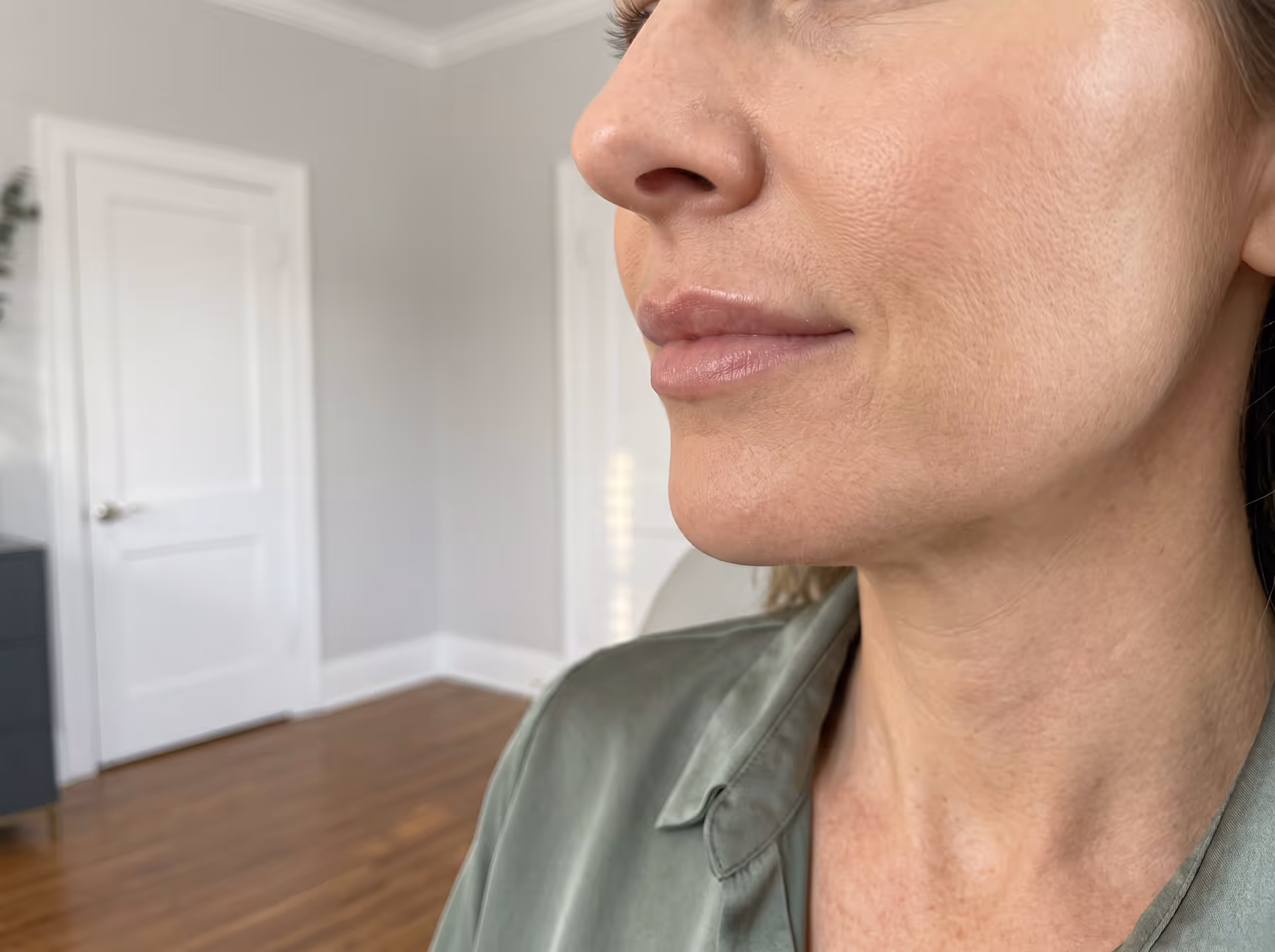 Dermal filler injection treatment at Charlotte Medical Aesthetics